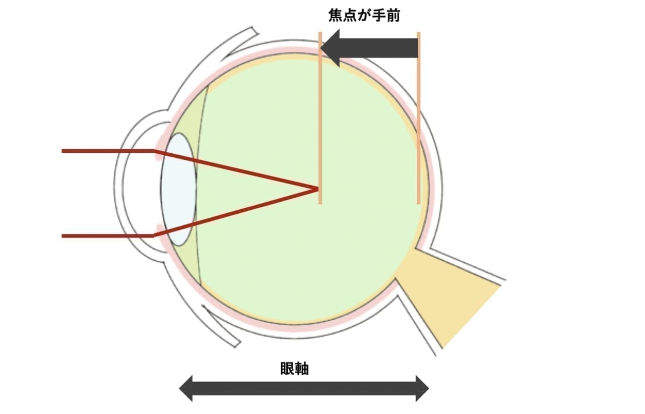 近視を治療する「クボタメガネ」
