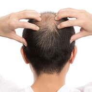 【薄毛対策の具体的な方法＆専門家のアドバイス】栄養バランスからストレス管理まで 健やかな髪を取り戻すための総合的アプローチ